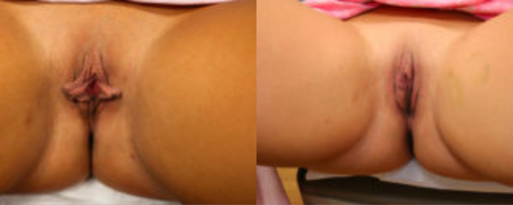 labiaplasty before and after results labiaplasty before and after results
