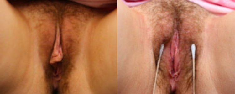 labiaplasty before and after results labiaplasty before and after results