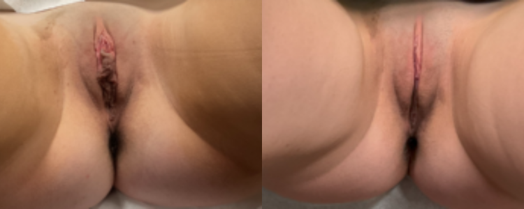 labiaplasty before and after results labiaplasty before and after results